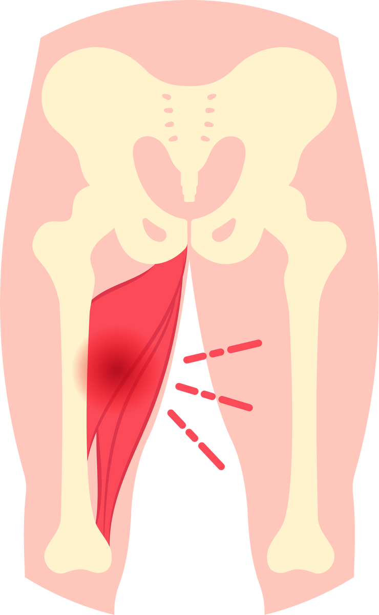 inflammation hip leg tear longus Pinched nerve brevis magnus thigh spasm anatomy gracilis hamstring medical area pelvis femur Tendinitis Sciatica bone range of motion stress fracture